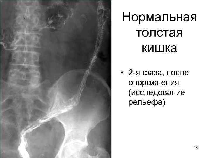 Нормальная толстая кишка • 2 -я фаза, после опорожнения (исследование рельефа) 16 