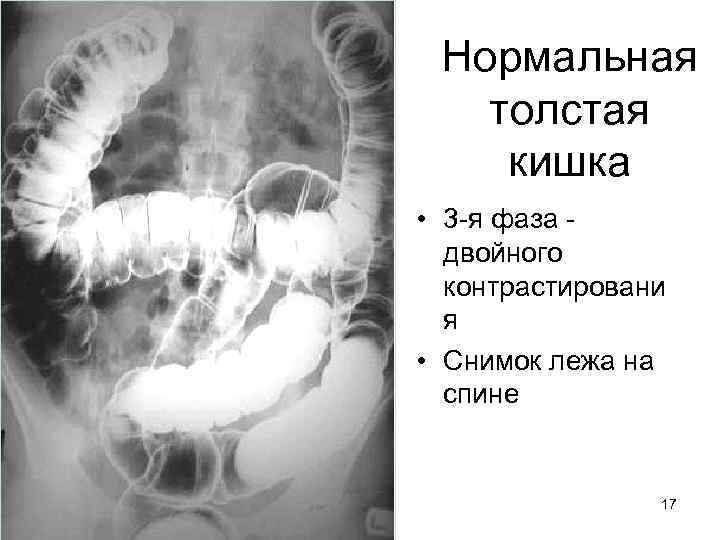 Нормальная толстая кишка • 3 -я фаза двойного контрастировани я • Снимок лежа на