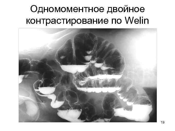Одномоментное двойное контрастирование по Welin 19 