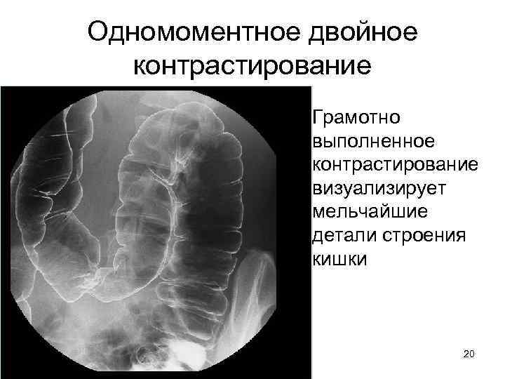 Одномоментное двойное контрастирование • Грамотно выполненное контрастирование визуализирует мельчайшие детали строения кишки 20 