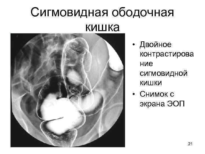 Сигмовидная ободочная кишка • Двойное контрастирова ние сигмовидной кишки • Снимок с экрана ЭОП