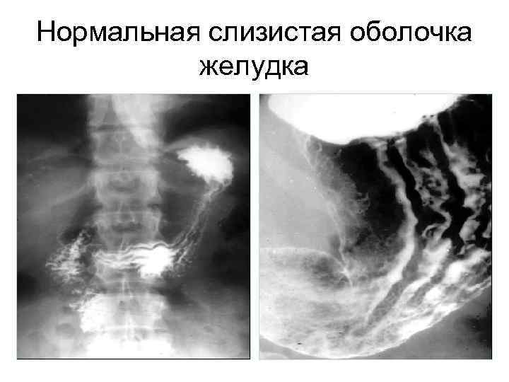 Нормальная слизистая оболочка желудка 24 