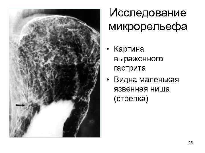 Исследование микрорельефа • Картина выраженного гастрита • Видна маленькая язвенная ниша (стрелка) 25 