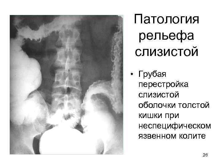 Патология рельефа слизистой • Грубая перестройка слизистой оболочки толстой кишки при неспецифическом язвенном колите