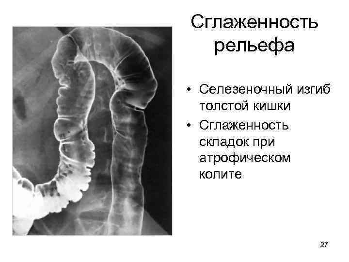 Сглаженность рельефа • Селезеночный изгиб толстой кишки • Сглаженность складок при атрофическом колите 27