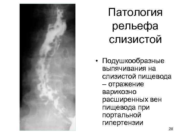 Патология рельефа слизистой • Подушкообразные выпячивания на слизистой пищевода – отражение варикозно расширенных вен