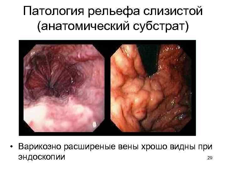 Патология рельефа слизистой (анатомический субстрат) • Варикозно расширеные вены хрошо видны при 29 эндоскопии