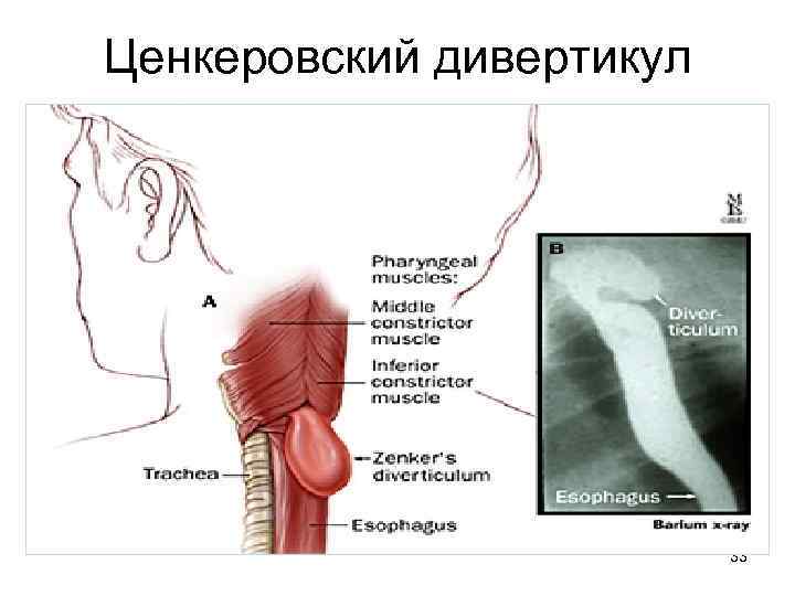 Ценкеровский дивертикул 33 