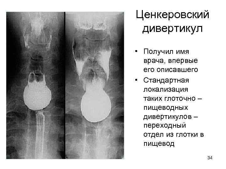 Ценкеровский дивертикул • Получил имя врача, впервые его описавшего • Стандартная локализация таких глоточно