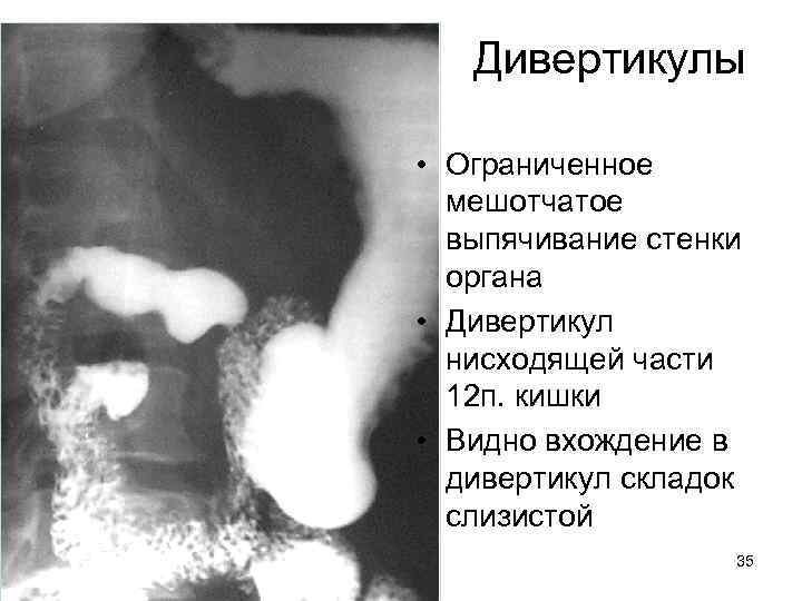 Дивертикулы • Ограниченное мешотчатое выпячивание стенки органа • Дивертикул нисходящей части 12 п. кишки