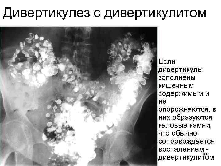Дивертикулез с дивертикулитом • Если дивертикулы заполнены кишечным содержимым и не опорожняются, в них