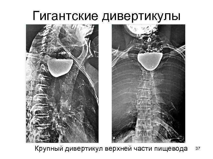 Гигантские дивертикулы Крупный дивертикул верхней части пищевода 37 
