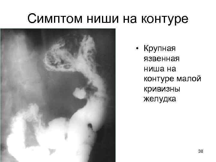 Симптом ниши на контуре • Крупная язвенная ниша на контуре малой кривизны желудка 38