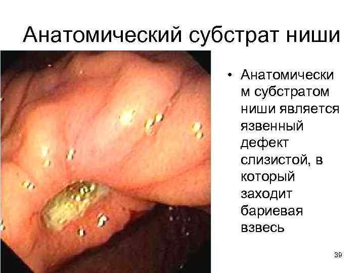 Анатомический субстрат ниши • Анатомически м субстратом ниши является язвенный дефект слизистой, в который
