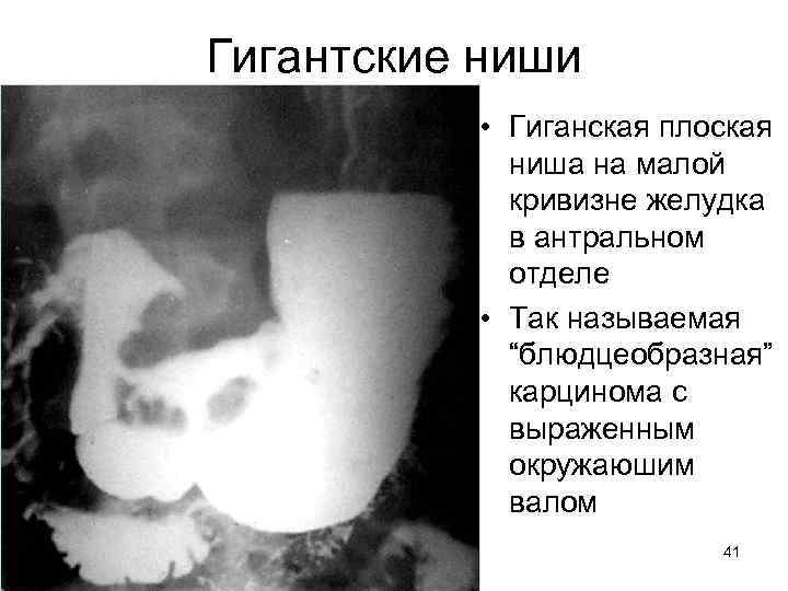 Гигантские ниши • Гиганская плоская ниша на малой кривизне желудка в антральном отделе •