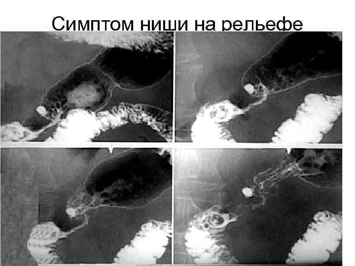 Симптом ниши на рельефе 42 