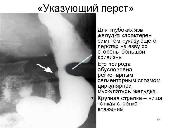  «Указующий перст» • Для глубоких язв желудка характерен симптом «указующего перста» на язву