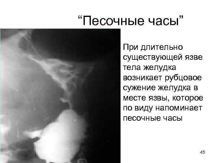 “Песочные часы” • При длительно существующей язве тела желудка возникает рубцовое сужение желудка в