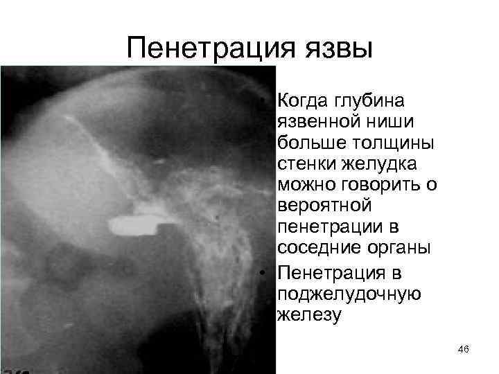 Пенетрация язвы • Когда глубина язвенной ниши больше толщины стенки желудка можно говорить о