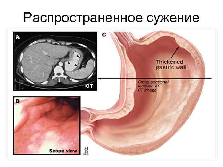 Распространенное сужение 49 