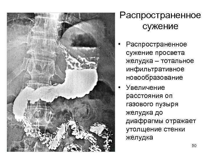 Распространенное сужение • Распространенное сужение просвета желудка – тотальное инфильтративное новообразование • Увеличение расстояния