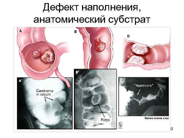 Дефект наполнения, анатомический субстрат 52 