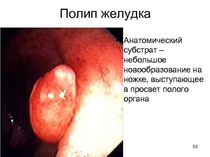 Полип желудка • Анатомический субстрат – небольшое новообразование на ножке, выступающее в просвет полого