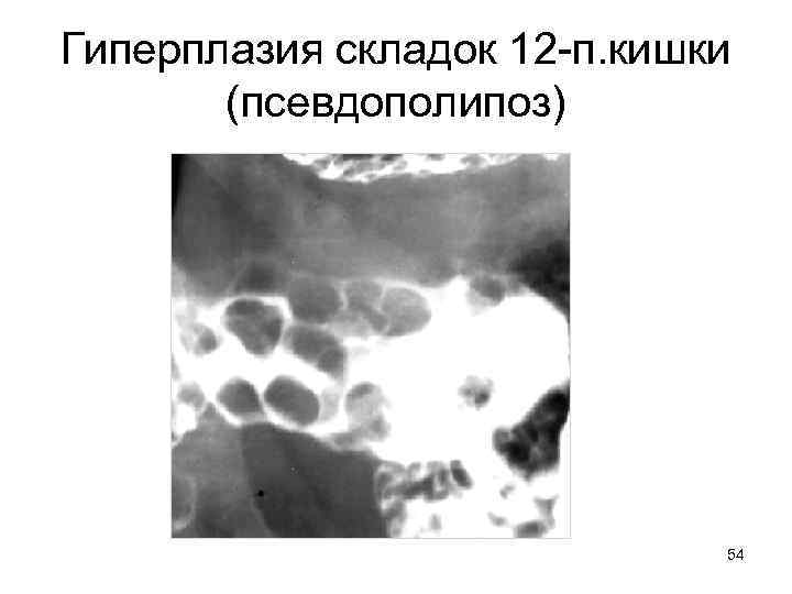 Гиперплазия складок 12 -п. кишки (псевдополипоз) 54 
