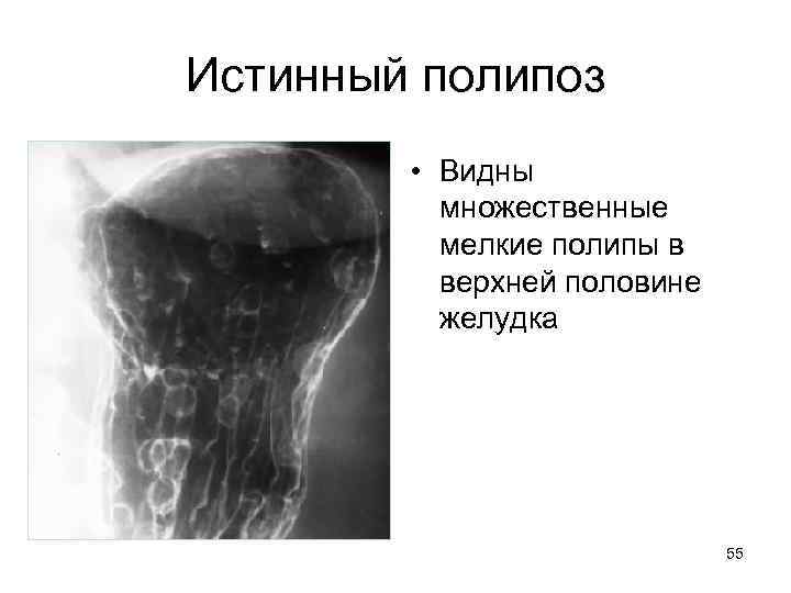Истинный полипоз • Видны множественные мелкие полипы в верхней половине желудка 55 