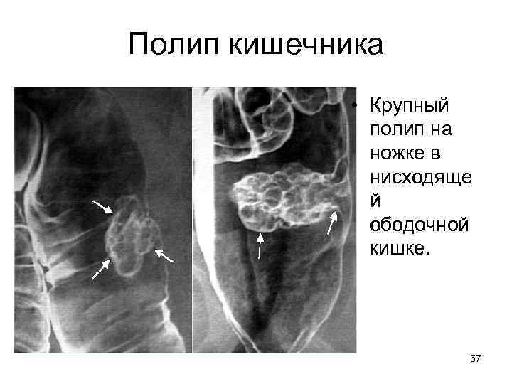 Полип кишечника • Крупный полип на ножке в нисходяще й ободочной кишке. 57 