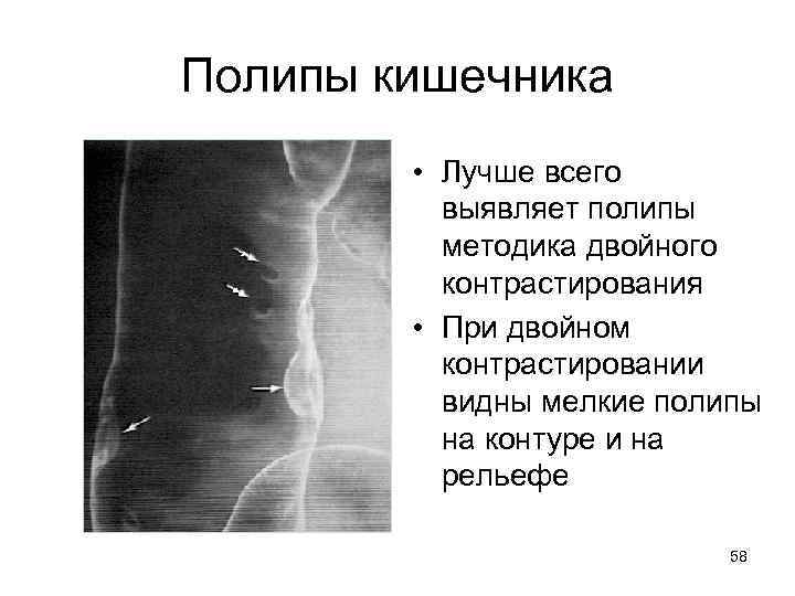 Полипы кишечника • Лучше всего выявляет полипы методика двойного контрастирования • При двойном контрастировании