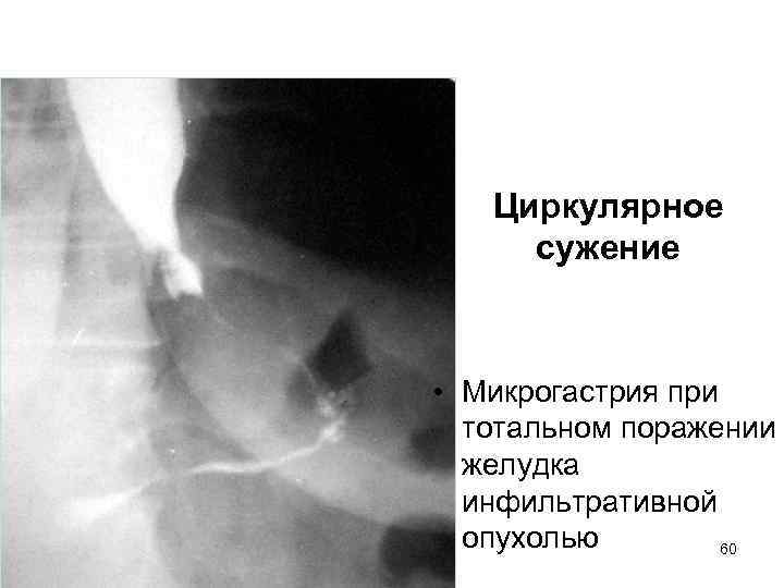 Циркулярное сужение • Микрогастрия при тотальном поражении желудка инфильтративной опухолью 60 