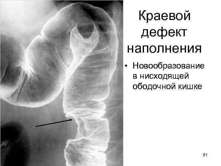 Краевой дефект наполнения • Новообразование в нисходящей ободочной кишке 61 