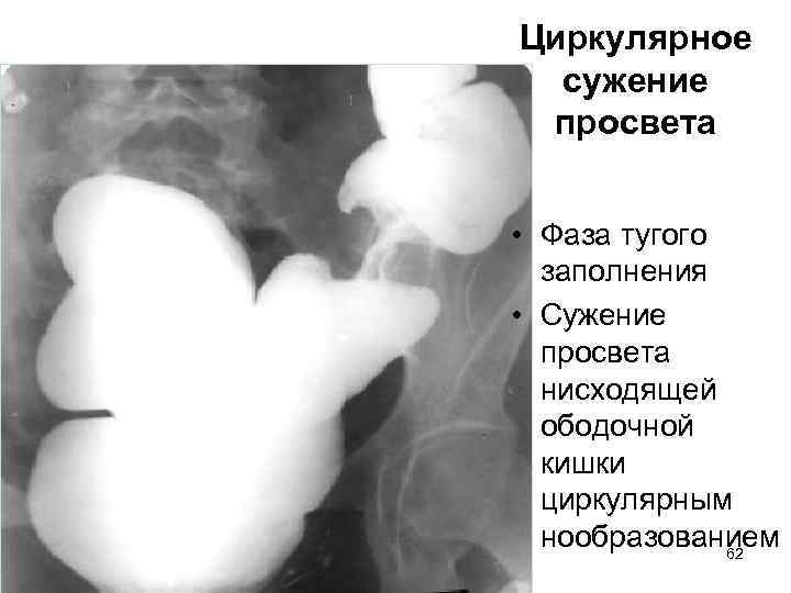 Циркулярное сужение просвета • Фаза тугого заполнения • Сужение просвета нисходящей ободочной кишки циркулярным