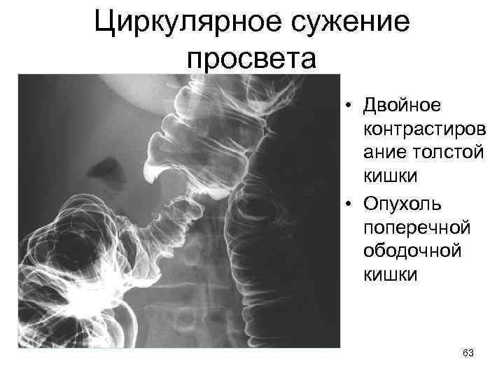 Циркулярное сужение просвета • Двойное контрастиров ание толстой кишки • Опухоль поперечной ободочной кишки