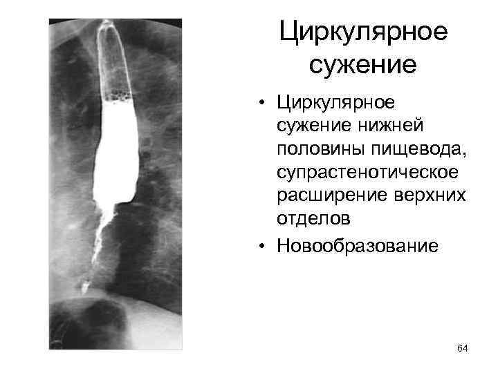 Циркулярное сужение • Циркулярное сужение нижней половины пищевода, супрастенотическое расширение верхних отделов • Новообразование