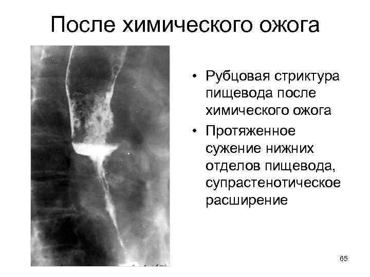 После химического ожога • Рубцовая стриктура пищевода после химического ожога • Протяженное сужение нижних