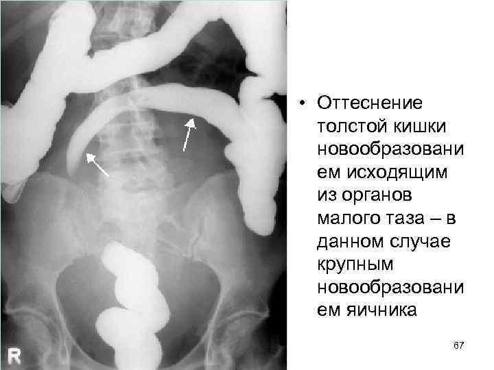  • Оттеснение толстой кишки новообразовани ем исходящим из органов малого таза – в