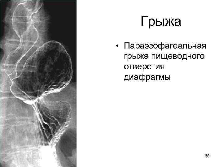 Грыжа • Параэзофагеальная грыжа пищеводного отверстия диафрагмы 68 