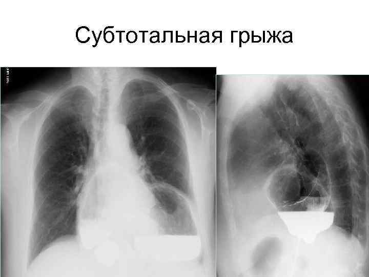 Субтотальная грыжа 69 