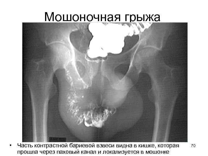 Мошоночная грыжа • Часть контрастной бариевой взвеси видна в кишке, которая прошла через паховый