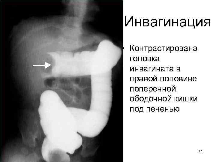 Инвагинация • Контрастирована головка инвагината в правой половине поперечной ободочной кишки под печенью 71
