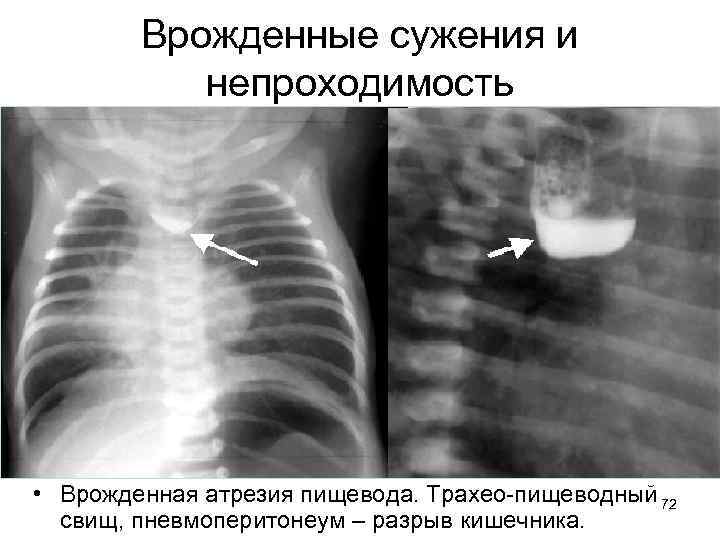 Врожденные сужения и непроходимость • Врожденная атрезия пищевода. Трахео-пищеводный 72 свищ, пневмоперитонеум – разрыв