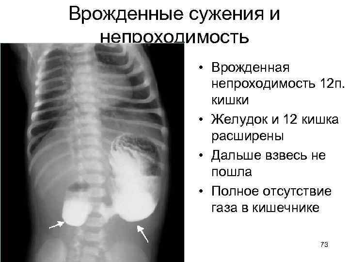 Врожденные сужения и непроходимость • Врожденная непроходимость 12 п. кишки • Желудок и 12