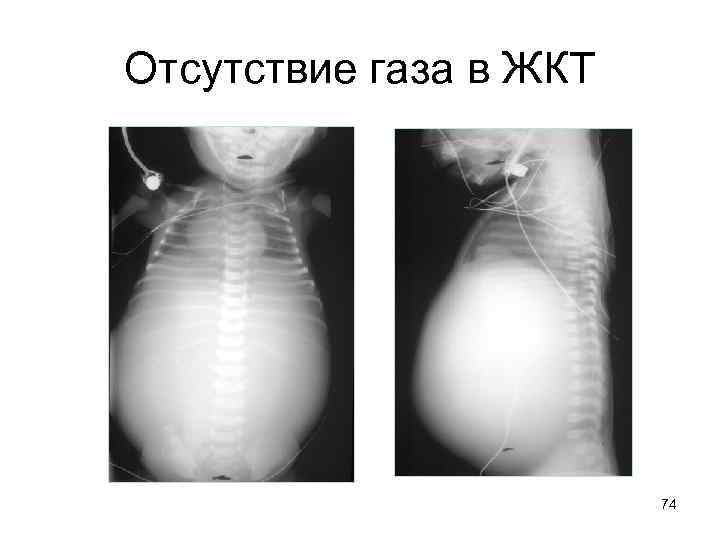 Отсутствие газа в ЖКТ 74 