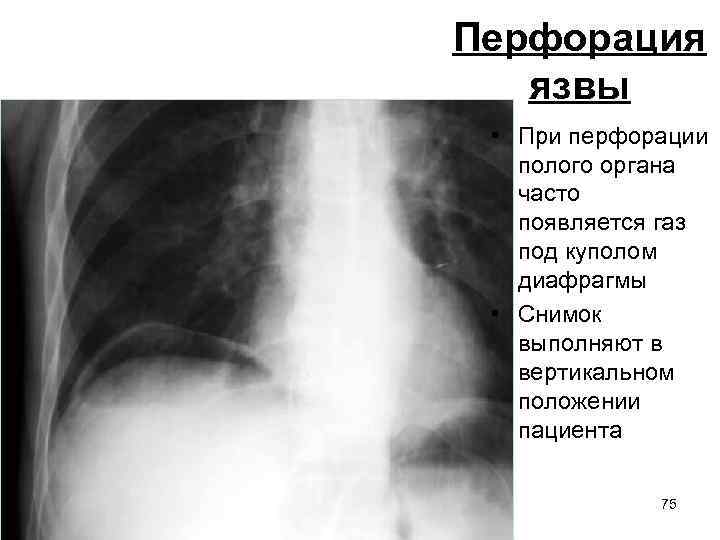 Перфорация язвы • При перфорации полого органа часто появляется газ под куполом диафрагмы •