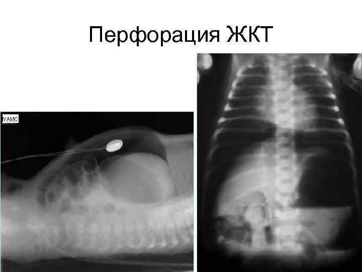 Перфорация ЖКТ 76 