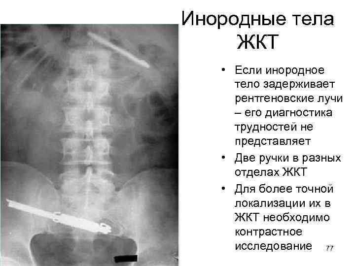 Инородные тела ЖКТ • Если инородное тело задерживает рентгеновские лучи – его диагностика трудностей