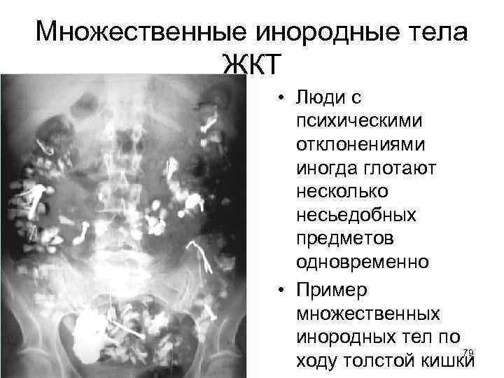 Множественные инородные тела ЖКТ • Люди с психическими отклонениями иногда глотают несколько несьедобных предметов