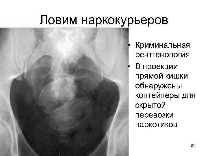 Ловим наркокурьеров • Криминальная рентгенология • В проекции прямой кишки обнаружены контейнеры для скрытой
